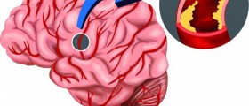 Reducing incidence of stroke with thrombolytics