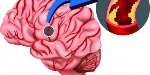Reducing incidence of stroke with thrombolytics