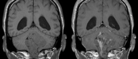 Marijuana and Brain Cancer: Are the Glowing Reports Really True?