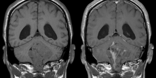 Marijuana and Brain Cancer: Are the Glowing Reports Really True?