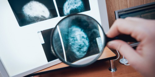 Breast Cancer Awareness Month: What You Need To Know About Screening Diagnostics Beyond Mammography