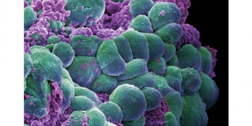 More Than 50% Of Women Affected By Lumpy Breasts Or Fibrocystic Breast Condition