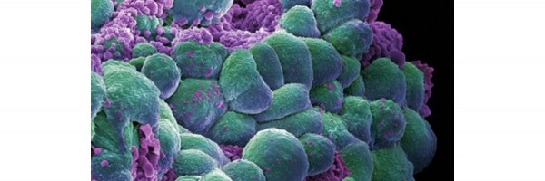 More Than 50% Of Women Affected By Lumpy Breasts Or Fibrocystic Breast Condition