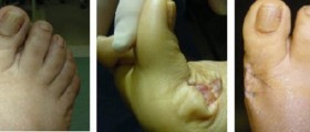 Bunion Removal (Bunionectomy): Preparing For Surgery and post OP recovery