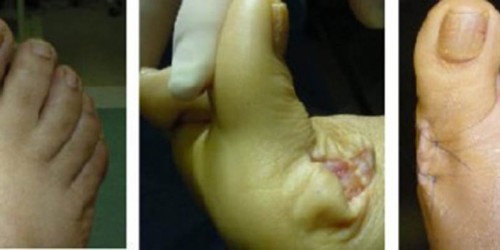 Bunion Removal (Bunionectomy): Preparing For Surgery and post OP recovery