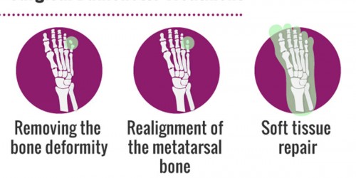 Bunionette Pain Relief: How To Treat Painful Little Toe
