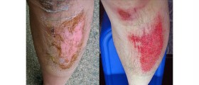 Home Remedies for Skin Burns and Cuts