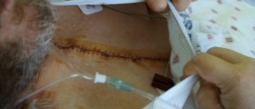 ECP: The New, Old Method For Bypassing Coronary Bypass