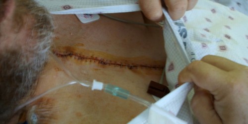 ECP: The New, Old Method For Bypassing Coronary Bypass