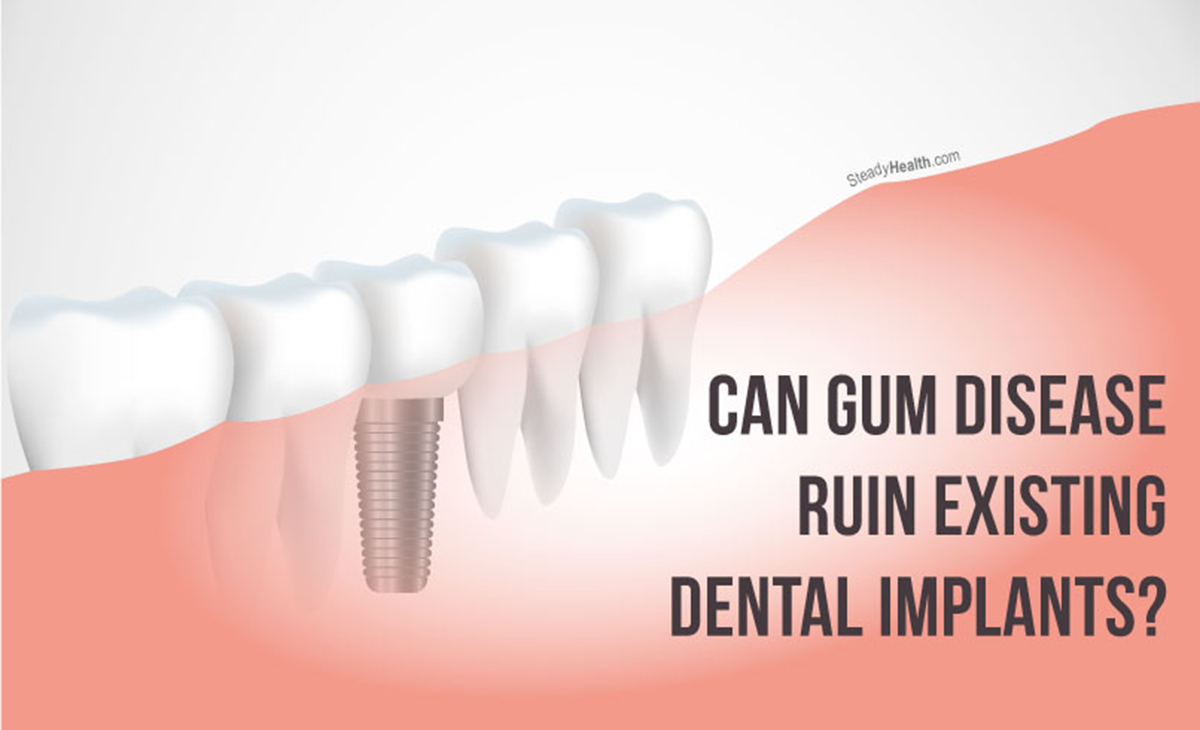 Can Gum (Periodontal) Disease Ruin Existing Dental Implants? Does It ...