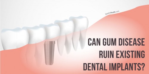 Can Gum (Periodontal) Disease Ruin Existing Dental Implants? Does It Make New Ones Impossible?