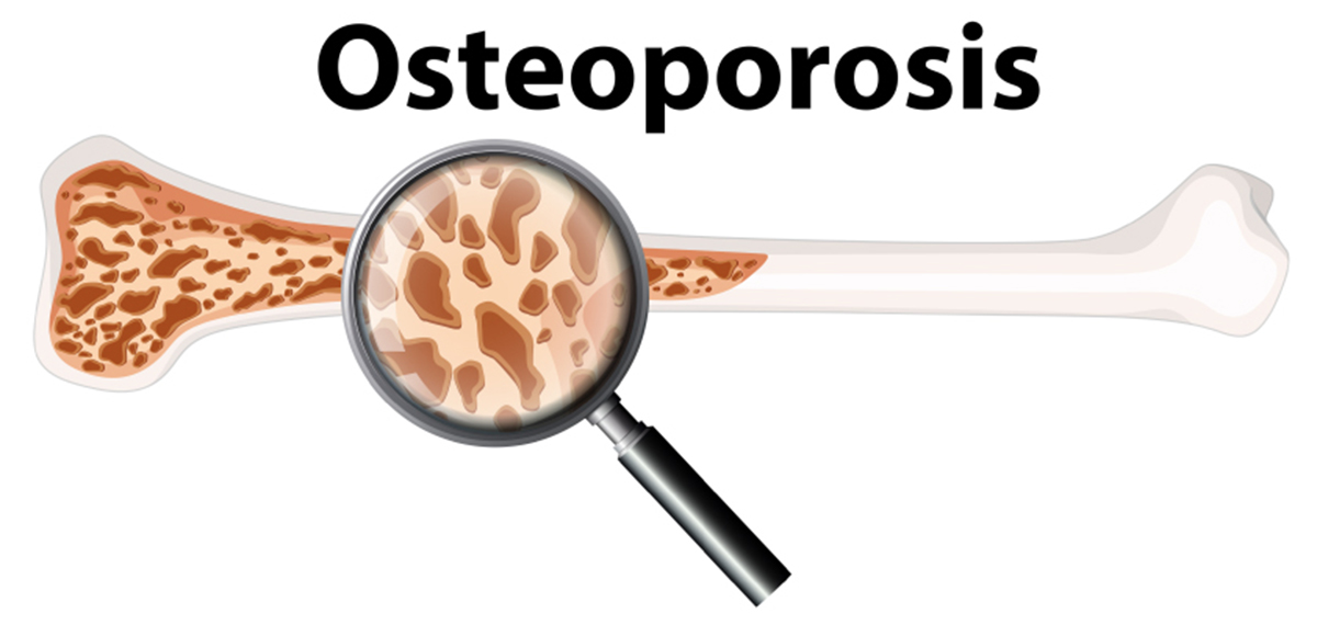 Can Strontium Boost Bone Health And Prevent Osteoporosis ...