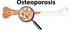 Can Strontium Boost Bone Health And Prevent Osteoporosis?