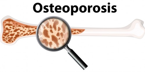 Can Strontium Boost Bone Health And Prevent Osteoporosis?