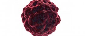 Brain Cancer - Treatment Alternatives