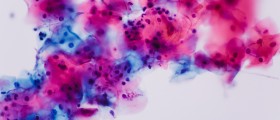 Diagnosed with Candida Infection! What now?