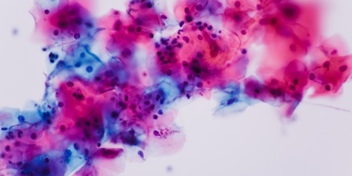 Diagnosed with Candida Infection! What now?