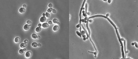 Vulvovaginal candidiasis (Vaginal thrush) therapy