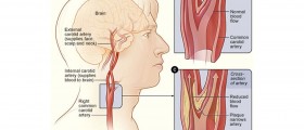Carotid Artery Disease: Stenosis Symptoms and Treatments