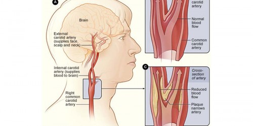 Carotid Artery Disease: Stenosis Symptoms and Treatments