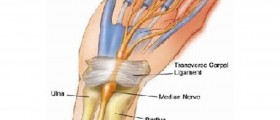 Numb hands relation to Carpal Tunnel Syndrome