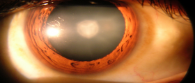 Cholesterol-Lowering Drugs Linked To Increased Risk Of Cataracts: Ten Things You Need To Know