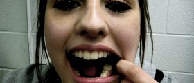 What Is The Best Way To Get Cavities Filled?