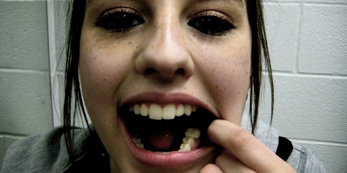 What Is The Best Way To Get Cavities Filled?