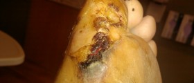 Cellulitis: Old Fashioned Cures Make A Comeback In A Nearly Post-Antibiotic World