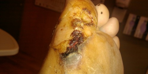 Cellulitis: Old Fashioned Cures Make A Comeback In A Nearly Post-Antibiotic World