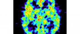 Hydrocephalus: Water on the Brain