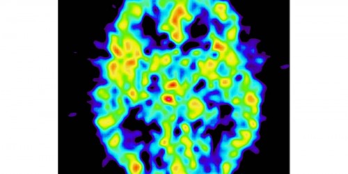 Hydrocephalus: Water on the Brain