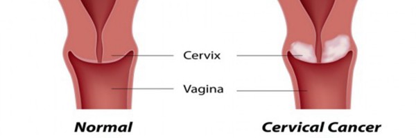 Cervical Cancer Screening & Prevention: The Most Important Ways to Prevent Cervical Cancer