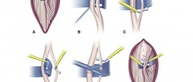 A Brief Guide To Cervical Rhizotomy