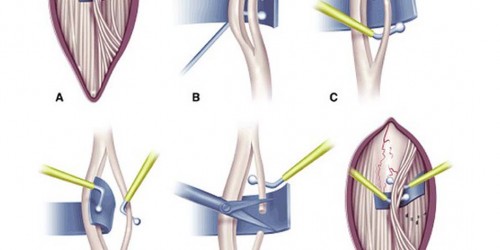 A Brief Guide To Cervical Rhizotomy