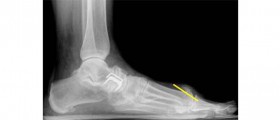 Cheilectomy