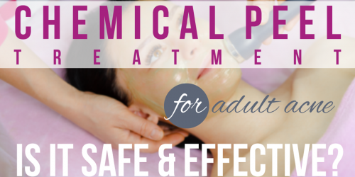 Chemical Peel Treatment For Adult Acne: Is It Safe And Effective?