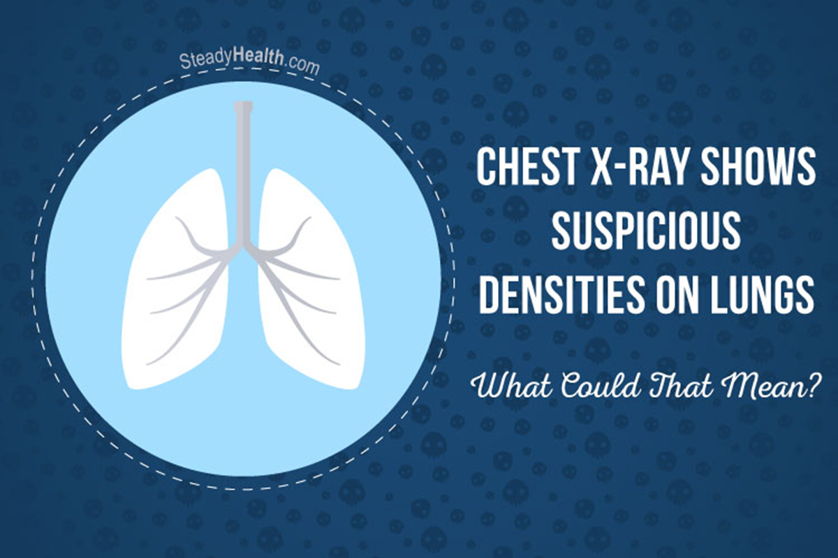 Chest X Ray Shows Suspicious Densities On Lungs What Could That Mean Respiratory Tract Disorders And Diseases Articles Body Health Conditions Center Steadyhealth Com