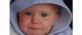 Once An Almost-Forgotten Disease, Measles Outbreak Strikes Children And Adults