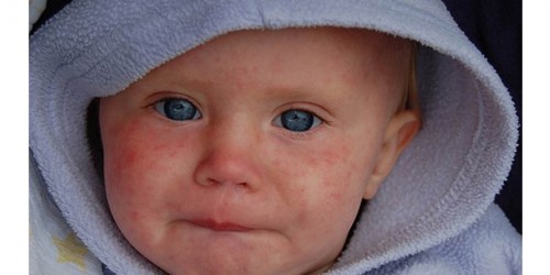 Once An Almost-Forgotten Disease, Measles Outbreak Strikes Children And Adults