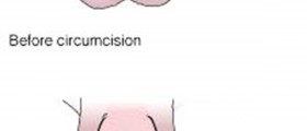 Circumcision: Pros and Cons