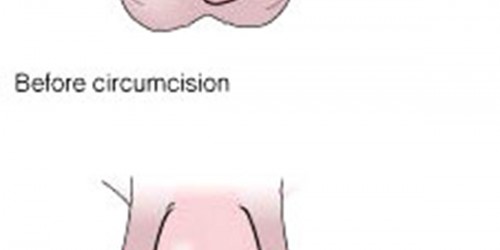 Circumcision: Pros and Cons