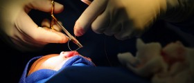 Cleft Lip And Cleft Palate: What To Expect