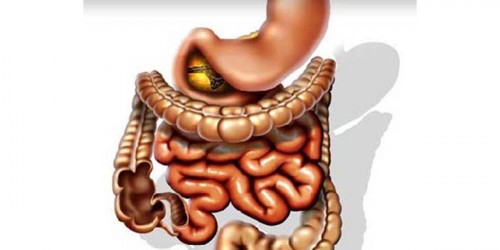 Nutrition in preventing colon cancer