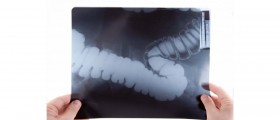 Colorectal (Colon) Cancer: Causes, Symptoms and Treatment