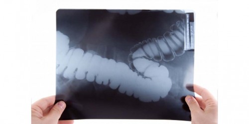 Colorectal  (Colon) Cancer: Causes, Symptoms and Treatment