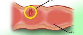 Are Colorectal Polyps Cancerous?