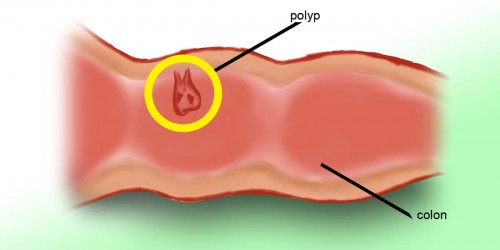 Are Colorectal Polyps Cancerous?