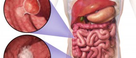 Chemotherapy For Colorectal Cancer