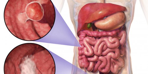 Chemotherapy For Colorectal Cancer